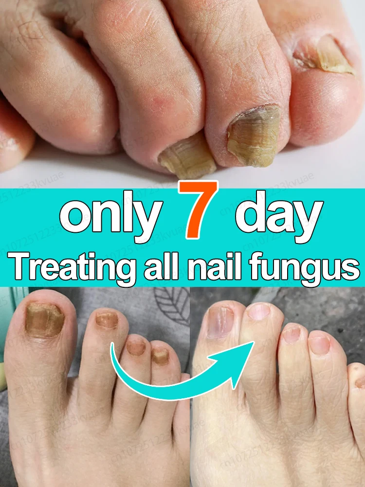 Organic Essential Oil with onychomycosis