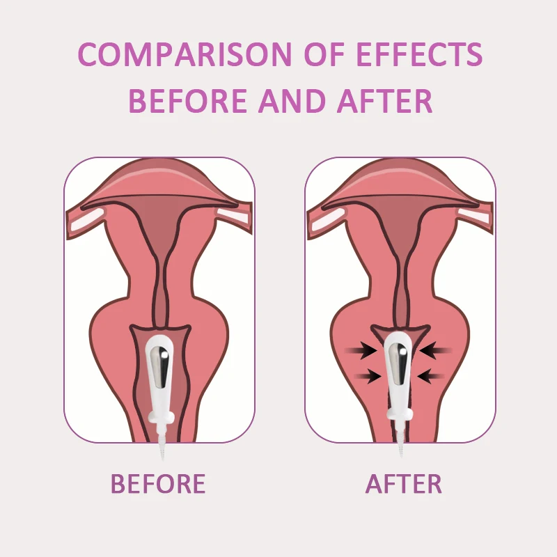 TENS/EMS Pelvic floor Muscle Stimulator Women Vaginal Trainer Kegel Exerciser Incontinence Sensation Tighten Dropshipping 2