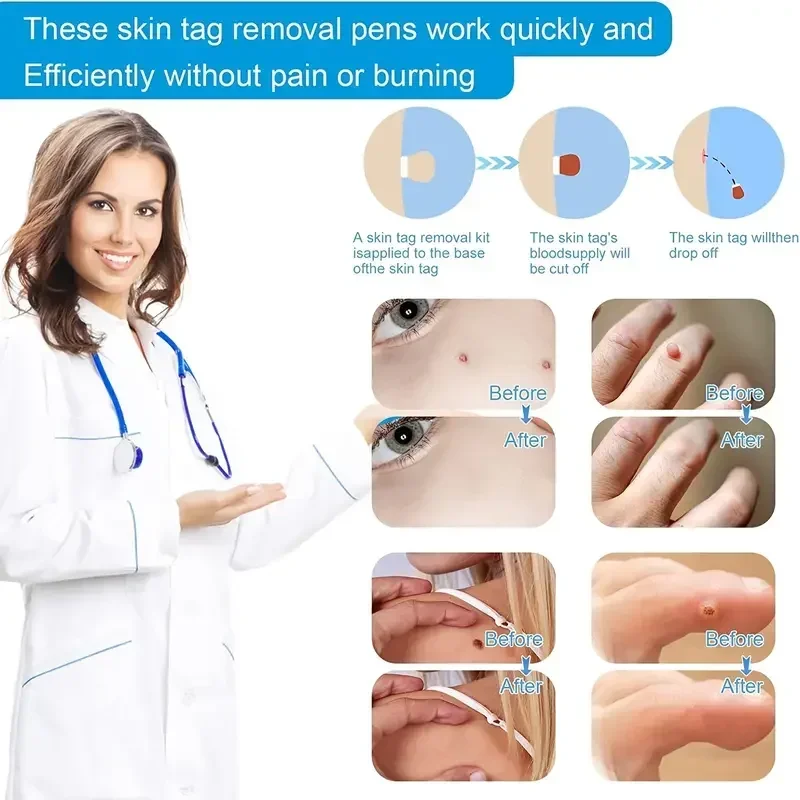 3 In1 Painless Auto Skin Tag Mole Wart Removal Kit Cleaning Tools Face Skin Care Body Wart Dot Treatments Remover Beauty Health skin tag removal tool skin tag removal pen