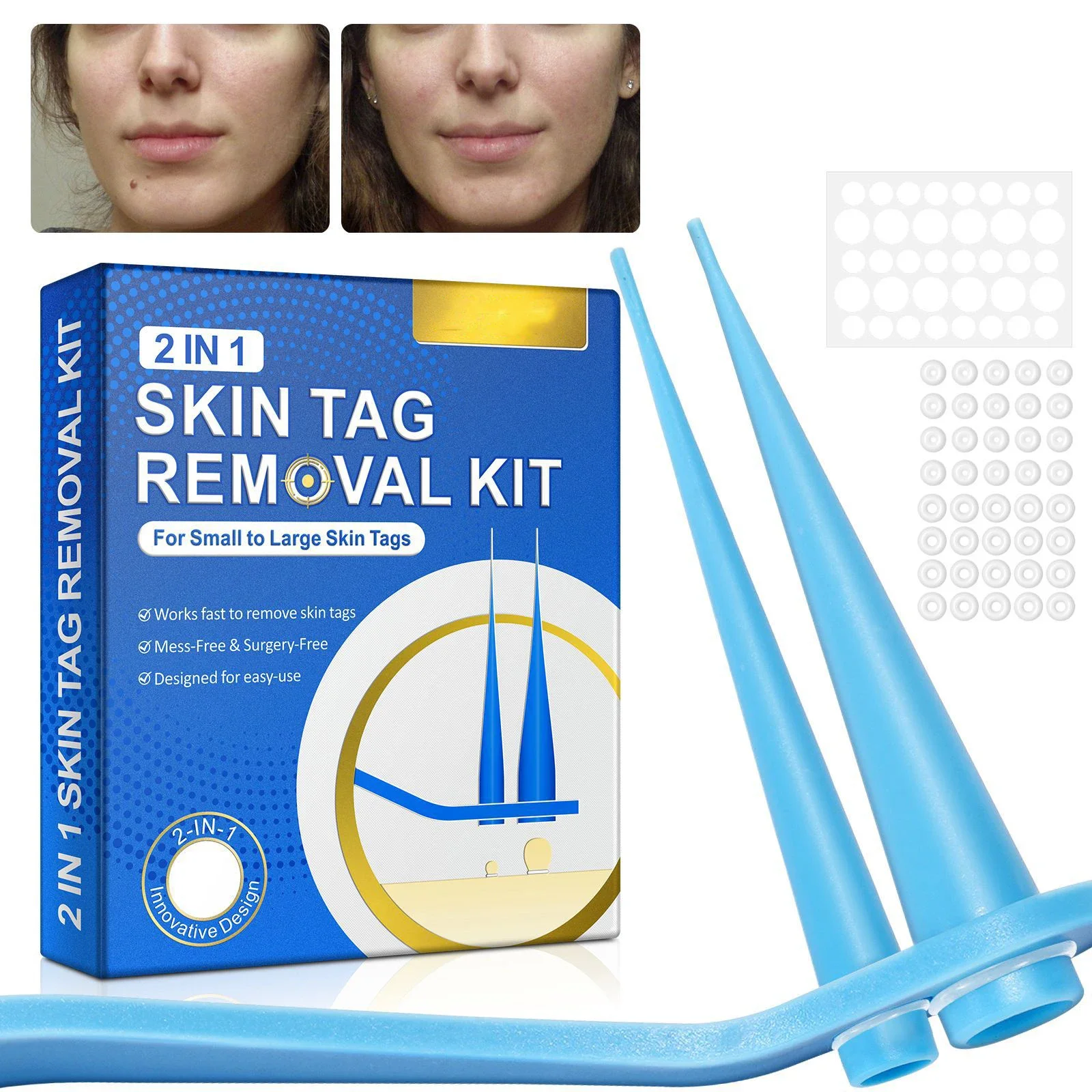 2 In 1 Auto Skin Tag Removal Kit Painless Mole Wart Remover Tool Easy Clean skin tag removal tool