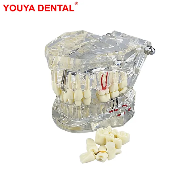Removable Teeth Model Implant Disease Dentist Studying New Dental Model Teeth Implant Restoration Bridge Teaching Demonstration