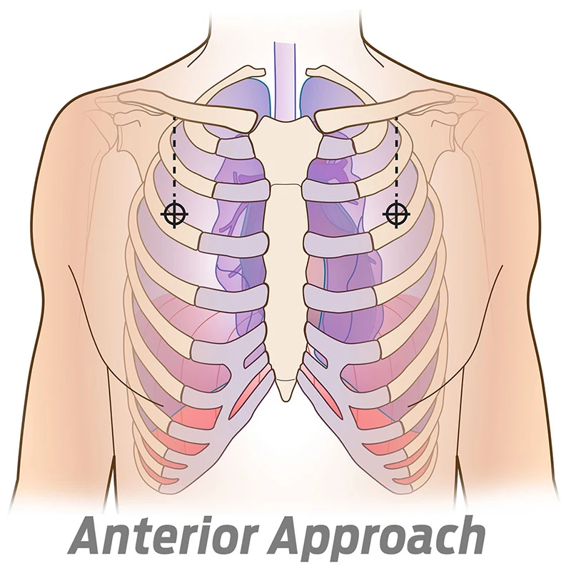 Rescue Pneumothorax Needle Trauma Medical Ifak Chest Cathether Needlecatheter Needle Decompression Edc First Aid Kit