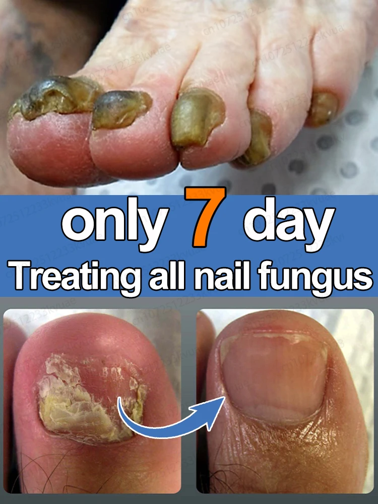 Nail fungus treatment essential oil, repair onychomycosis in 7 days