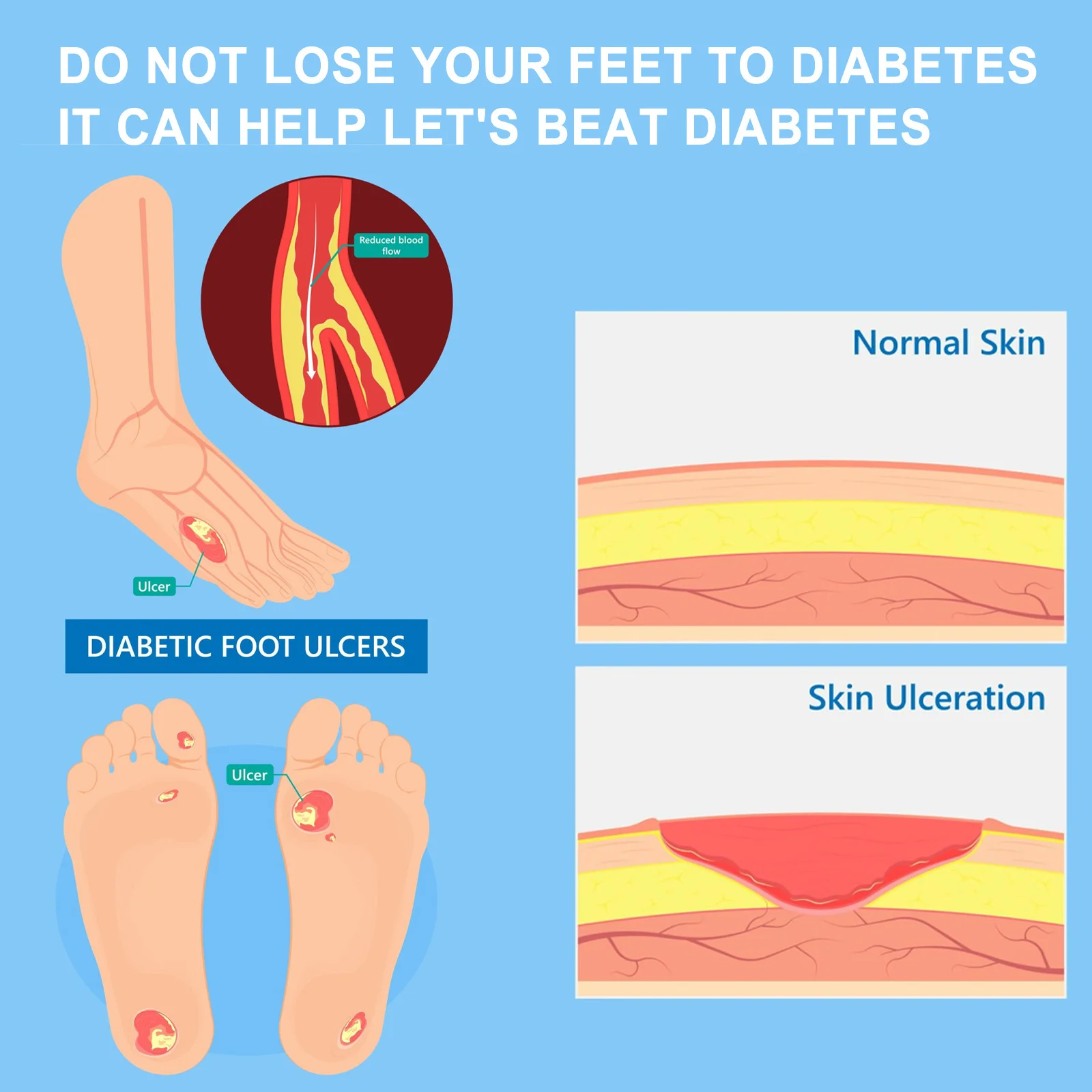 Diabetes Treatment Foot Cream Repair Feet Ulceration Relieve Itchy Improve Heel Cracking Nourishing Blood Sugar Care Ointment