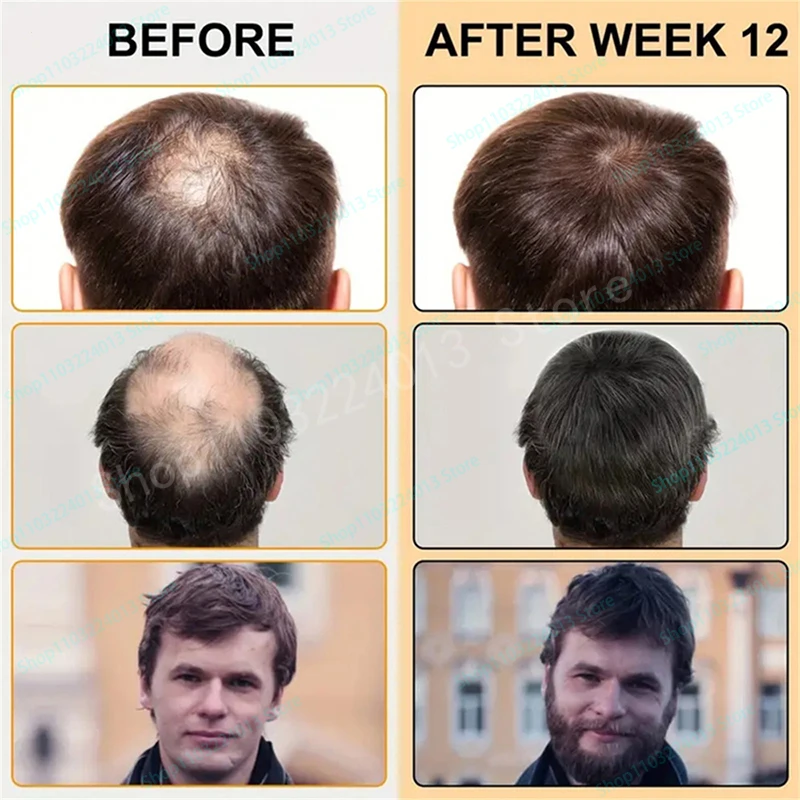 Description Picture 6 of itemAnti Alopecia Fast Hair Growth Oil Ginger Essential Serum Hairless Baldhead Increase High Hairline Natural Head Hair Essence