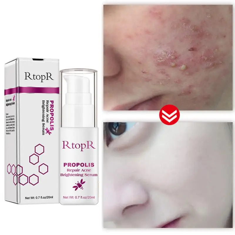 

Propolis Acne Removal Face Serum Hydrating Nourish Lighten Facial Skin Firming Skin Shrink Pores Cosmetics Makeup