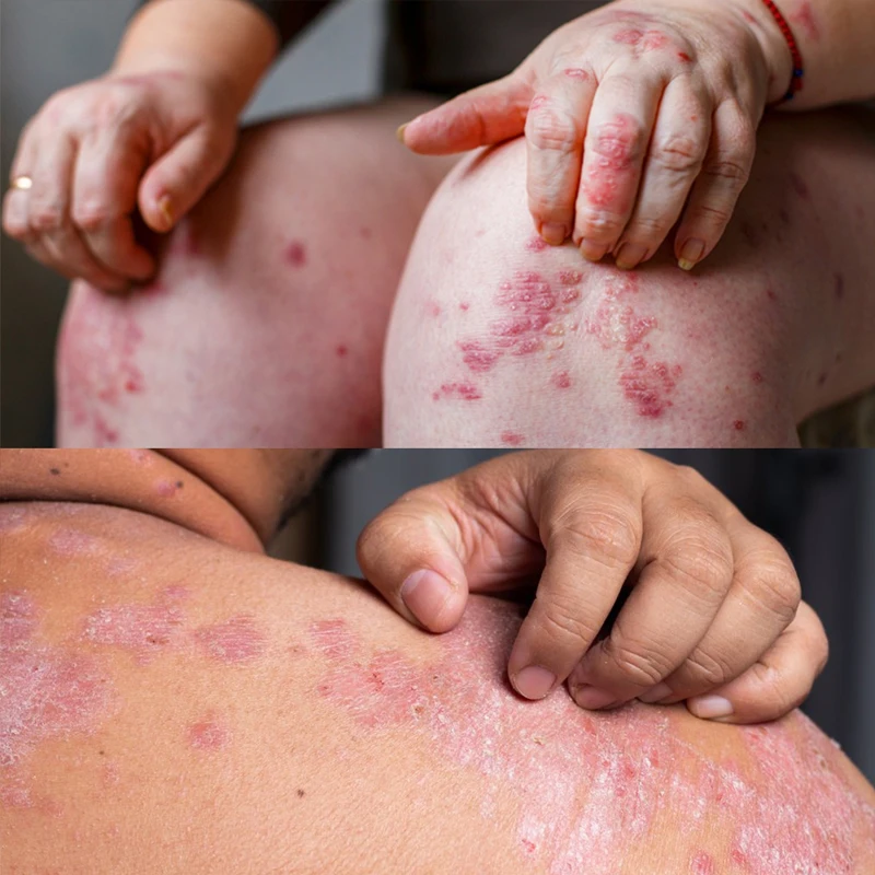 Natural Plant Extract Psoriasis Dermatitis Eczematoid Eczema Ointment Anti-Itch Chinese Herb Medical Skin Care Cream 15/30/50g