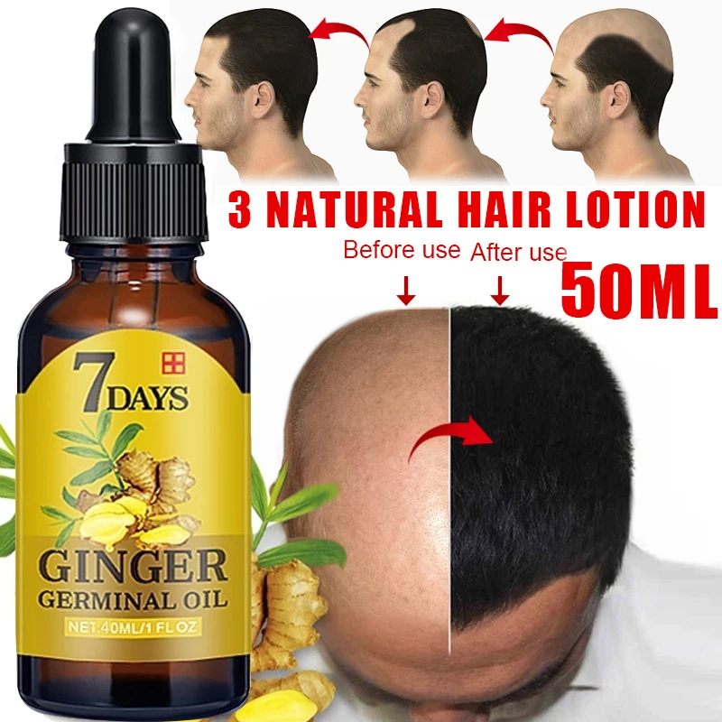 Hair Growth Products Ginger Fast Growing Hair Essential Oil Beauty Hair  Care Prevent Hair Loss Oil Scalp Treatment For Men Women | Hair Growth  Products Ginger Fast Growing Hair Essential Oil Beauty