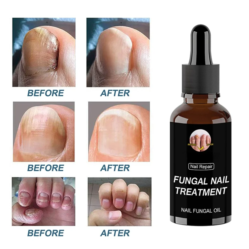 

Essential Oils Nail Fungus Treatment for Toenail Extra Strength Antifungal Solution Fungal Nail Toe and Fingernail