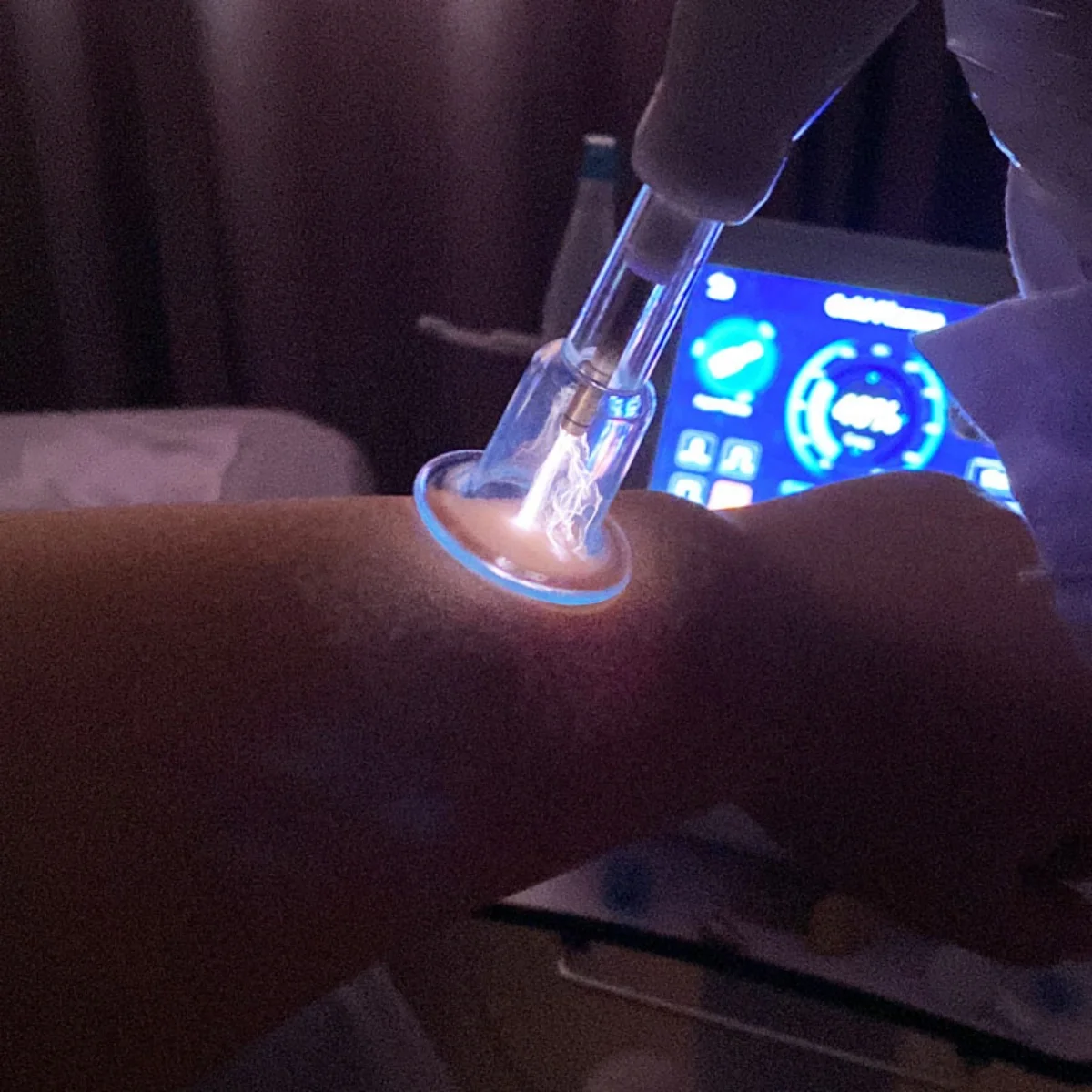 6 In 1 Professional Jet Plasma Lifting Skin Tightening Ozone Fibroblast Cold Plasma Pen Beauty Machine
