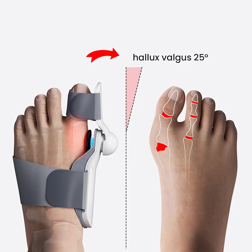 Big Toe Separator Hallux Valgus Bunion Corrector Orthotics Feet Bone Finger Correction Pedicure Adjustable Finger Straightener