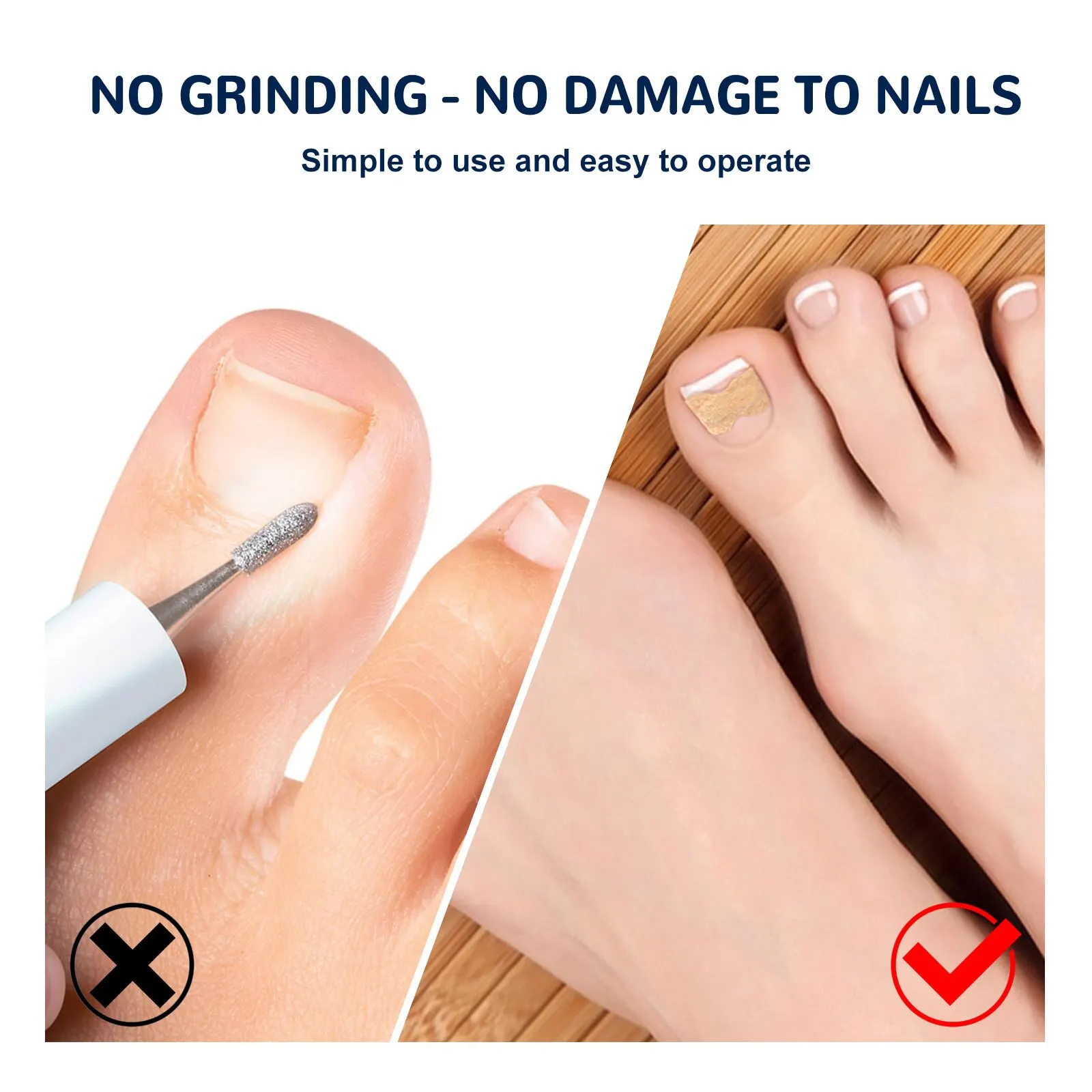 Ingrown Toenail Corrector Sticker 100Pcs Foot Care Pedicure Foot Orthodontic Toe Thumb Nail Care Patches,ingrown toenail correction tool,manicure pedicure tool set,foot care tool,foot pedicure tool,foot care patches,toe corrector,nail problem solving
