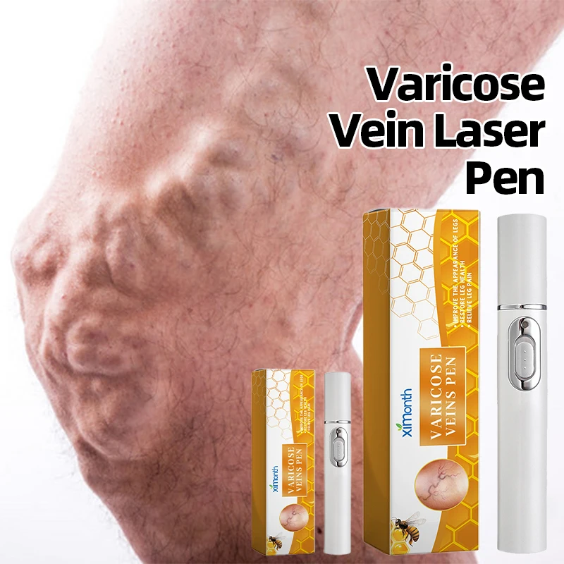 Varicose Veins Laser Therapy Pen Relieve Leg Pain Improves Moderate Varicose Vein Improve Blood Circulation For Men And Women