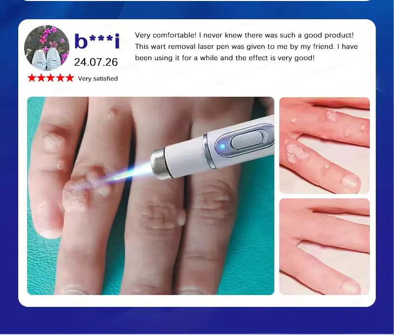 Penna a luce blu a massima potenza per la rimozione di verruche comuni e plantari, strumento per la cura delle verruche._voghion.com