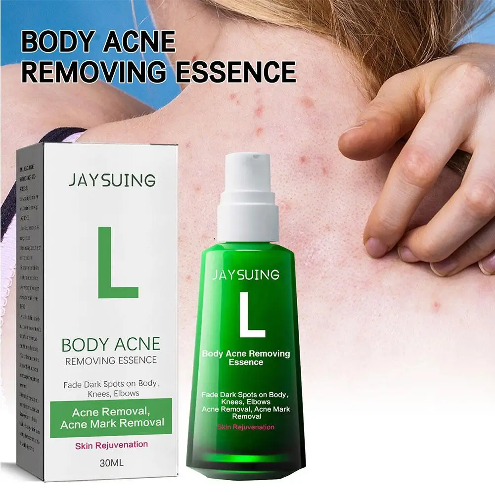 30ml Acne Remover Face Serum Herbs Acne Treatment Pimple Remover Shrink Pores Oil Control Face Herb Acne Skin Care_voghion.com