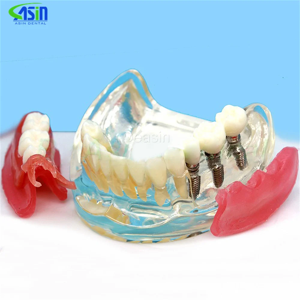 Modelo De Implante De Dentes Removíveis, Modelos