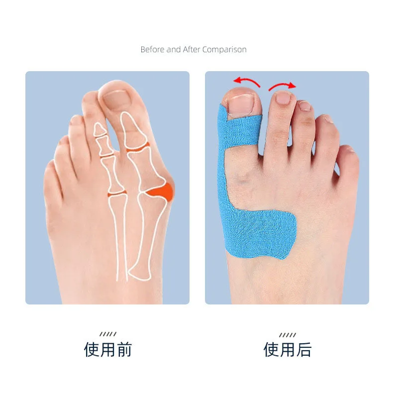 10Pcs Bunion Corrector Orthopedic Bunion Strap Breathable Toe Separator Hallux Valgus Orthosis Corrector for Big Toe Correction toe separators toe corrector