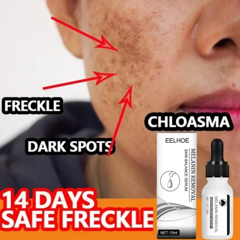 

Niacinamide Dark Spots Remover Serum Freckle Whitening Moisture Powerful Removal Black Dot Melasma Chloasma Face Skin Care Cream