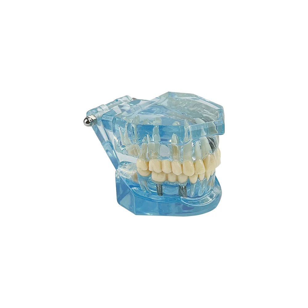 Teeth Repair Model Disease Teeth Model for Dentist Student Practice Training Studying Oral Medical Dentistry Tools
