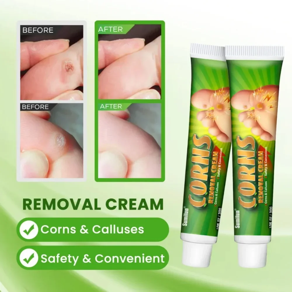 Foot Corn Remover Cream Chicken Eye Skin Infection Treatment Ointment Feet Dead Skin Calluses Removal Tool Health Care 30g