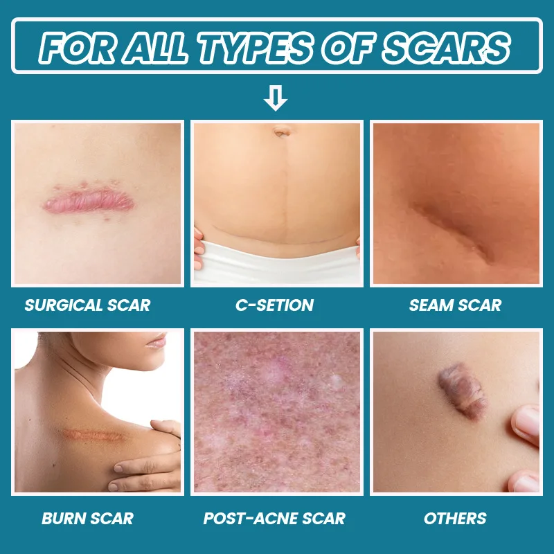 Liquid Bandage Spray ERAYCEE Thin Scar Gel Thin Scar Scald Abdominal Skin Care