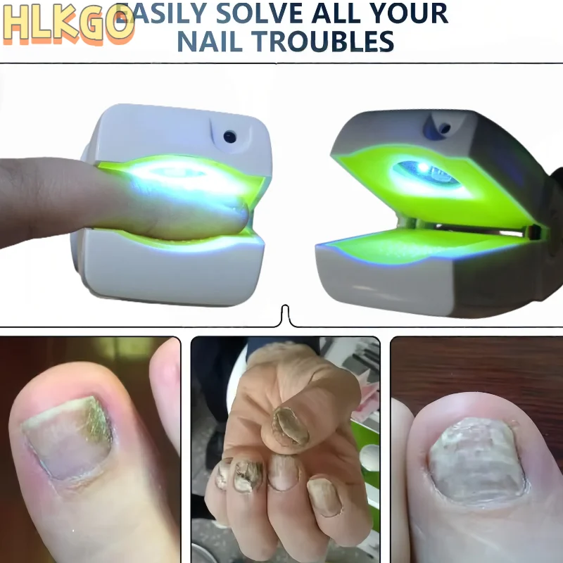 Professional Medical Grade Toenail Fungus Treatment Device for Immediate Repair & Effective Ringworm Elimination