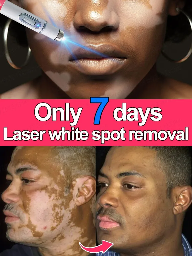 Merhemler Vitiligo Merhemleri Nedir ve Hangi Ürünler En Etkilidir?