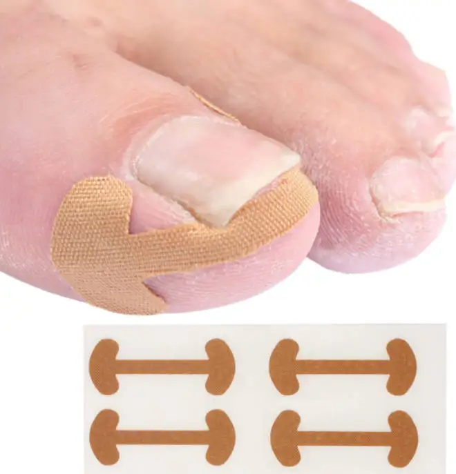 Nail Correction Stickers 100pcs Professional Painless Ingrown Toenail Correction Strips Waterproof Breathable Treatment Pedicure