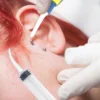 Tonsil Stone Extractor Ear Wax Removal Machine Earwax Remover Irrigation Syringe Vacuum Cleaner 3