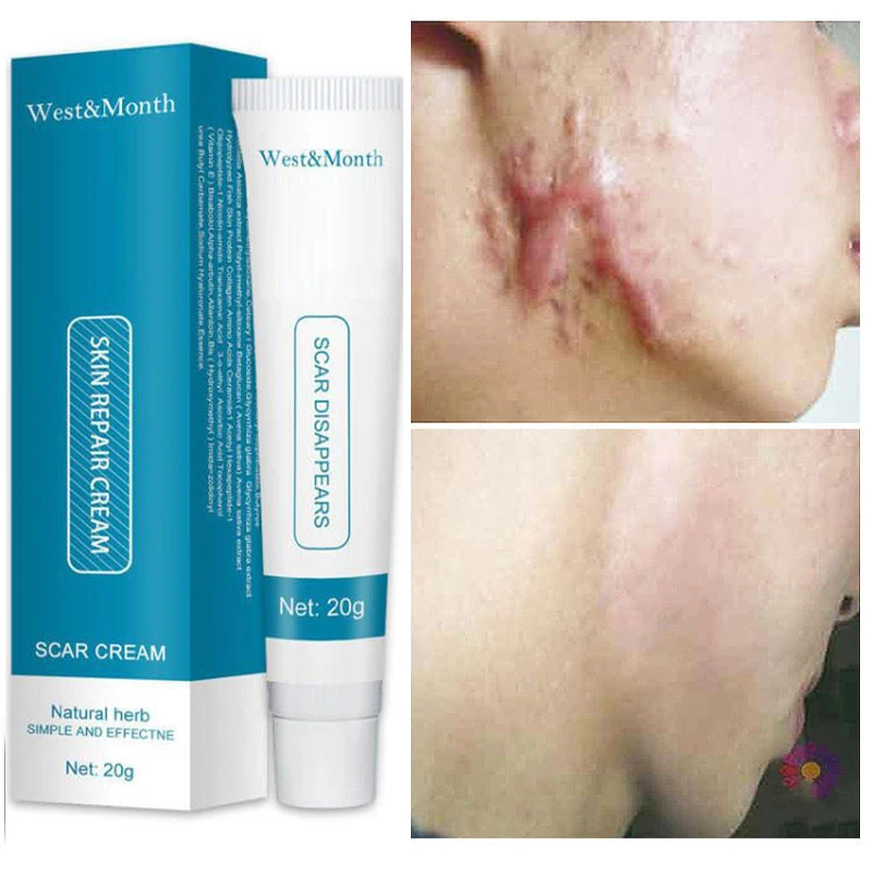 The Best Scar Creams Of 2022 By InStyle Scar Removal Cream Stretch