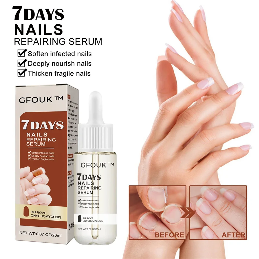 

7day Nail Fungal Oil Nail Repair Feet Care Anti-Fungus Onychomycosis Removal Liquid Anti Accessories
