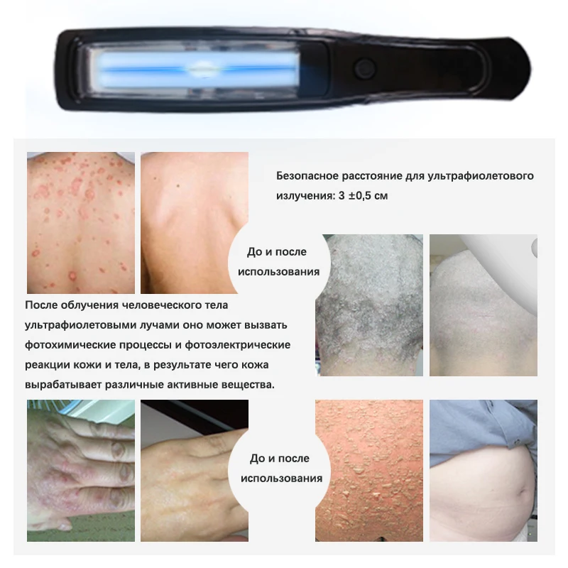 UVB Lamp for Therapy Psoriasis Lamp Skin Treatment Light 308NM Narrowband Ultraviolet Vitiligo Phototherapy Instrument - Image 4