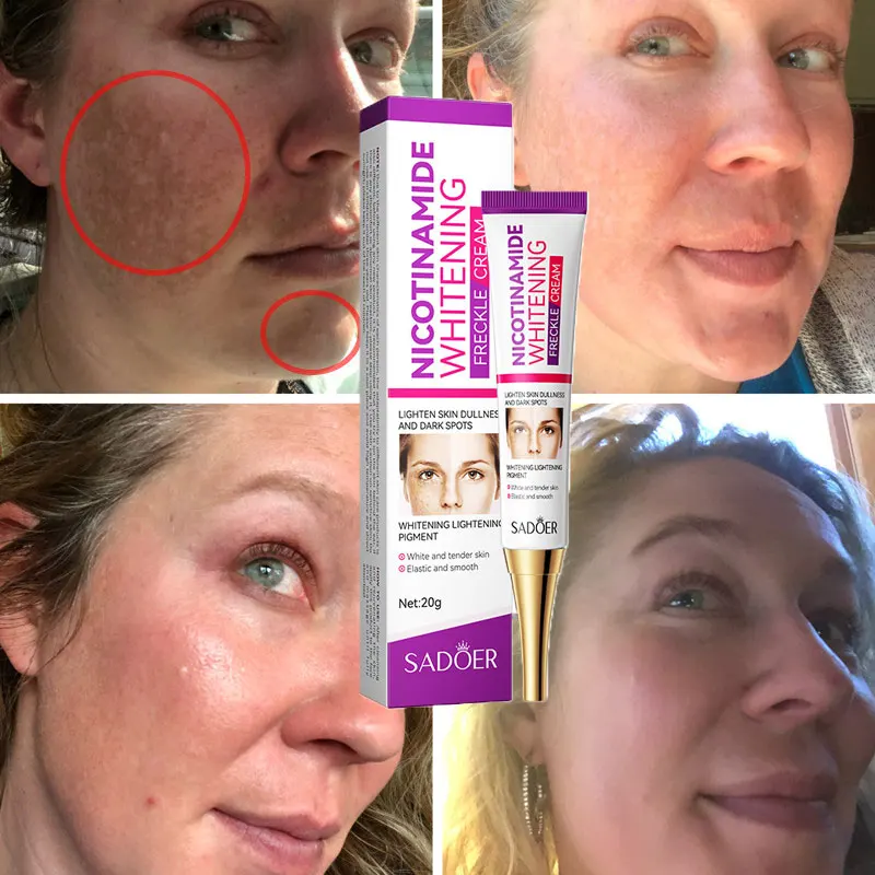 

Whitening Freckle Cream Nicotinamide Remover Melasma Cream Remove Dark Spots Melanin Moisturize Brighten Smooth Face Skin Care