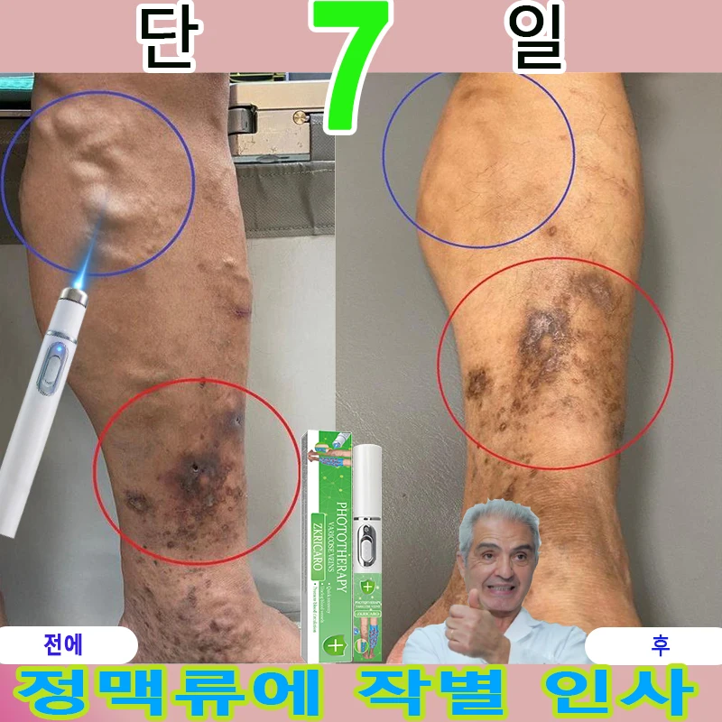 정맥류에 작별 인사
