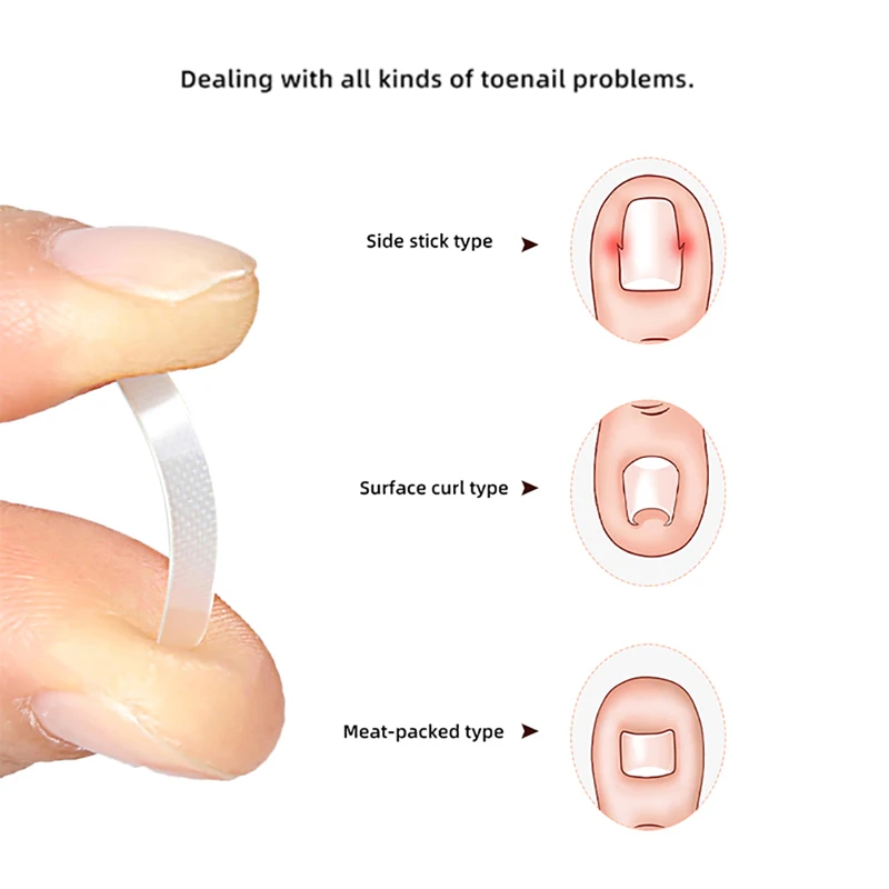 alt="10pcs Ingrown Toenail Correction Tool, a Straightening Clip Brace for Ingrown Toe Nails.