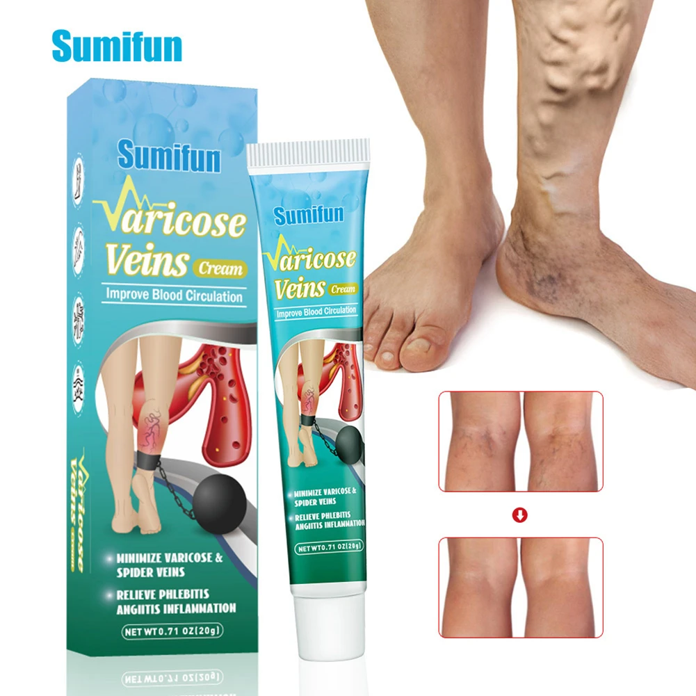 1pcs 20g Varicose Veins Treatment Cream Vasculitis Phlebitis Thigh