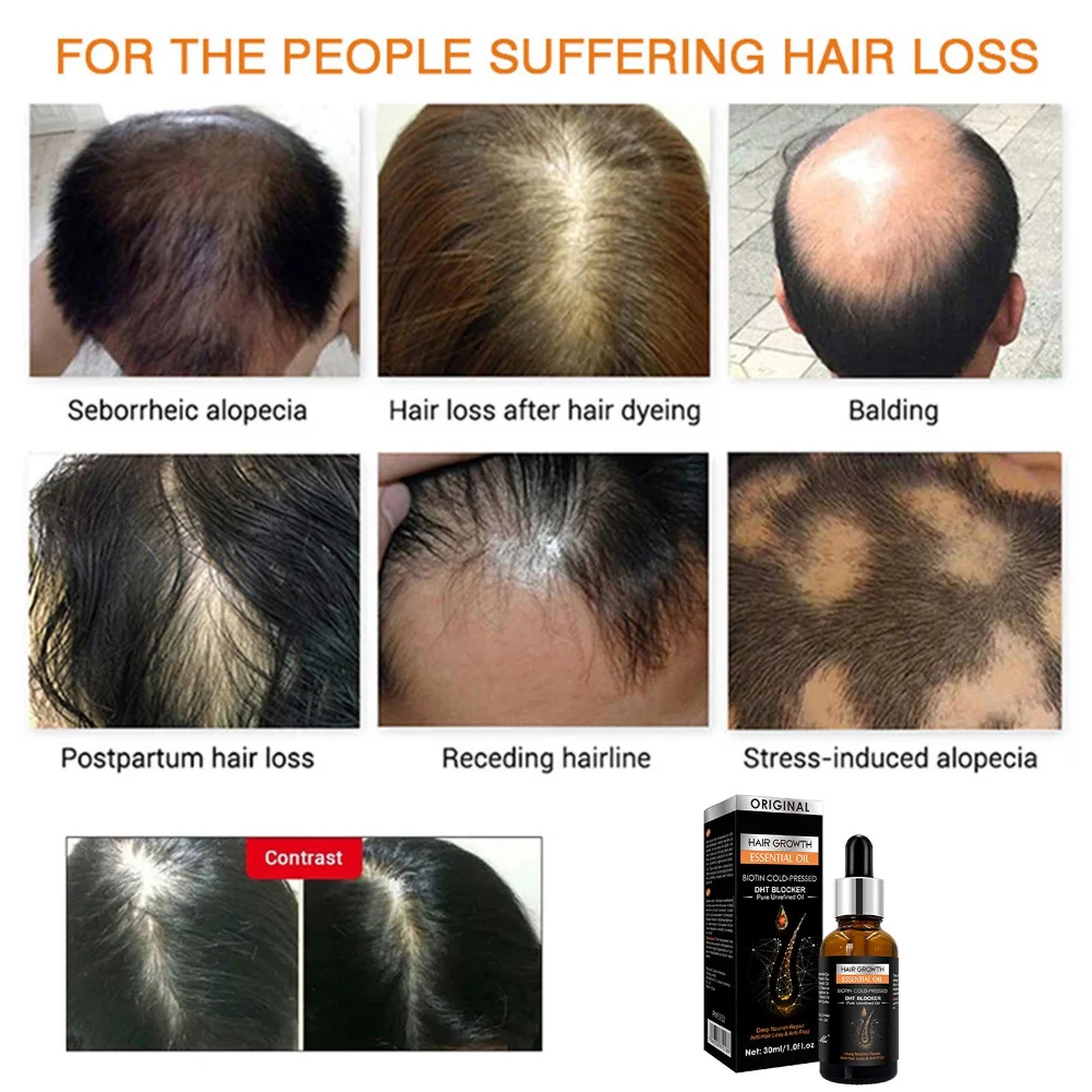 Hair Growth Essential Oil Biotin Cold-Pressed DHT Blocker Hair Growth Shampoo Anti-Hair Loss Conditioner Accessories hair growth serum hair growth spray hair care oil hair growth cream hair growth shampoo set
