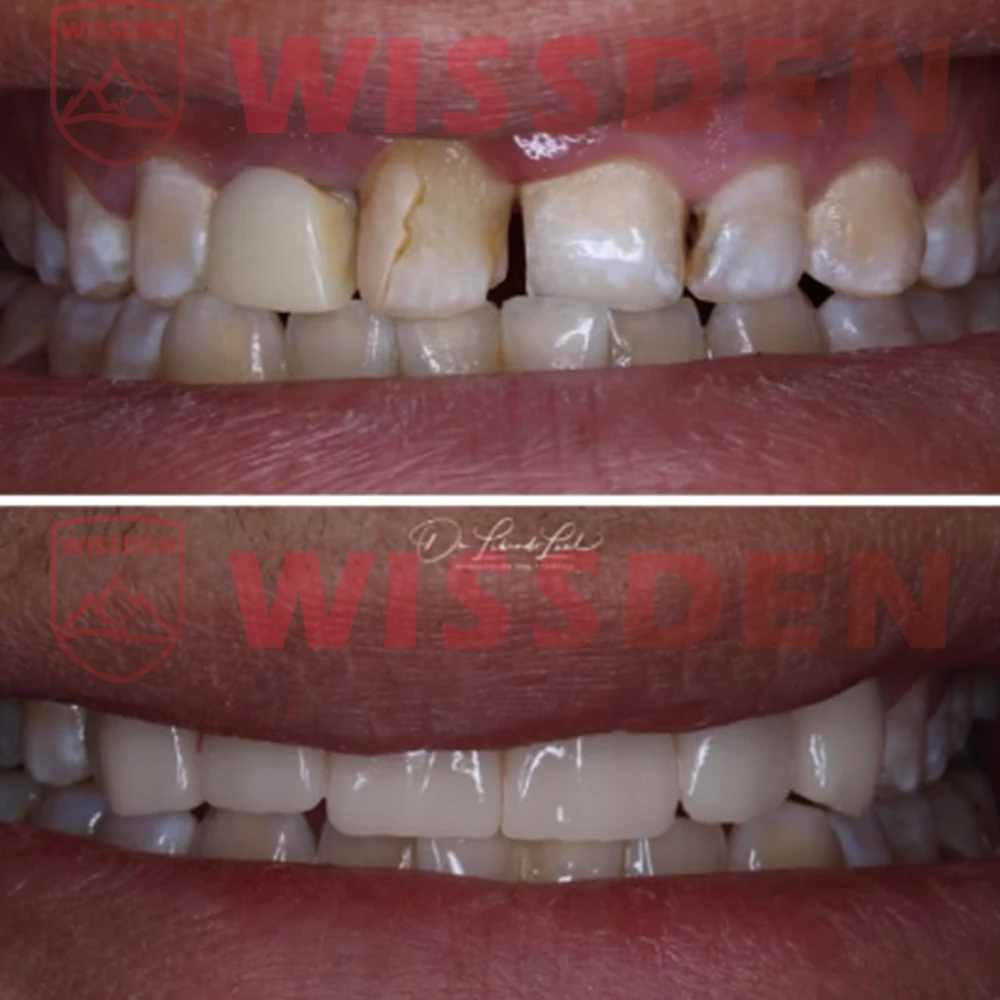 5 Pieces C14 Lithium Disilicate Blocks Cerec emax CAD Wissden Dental Glass Ceramic Cubes HT/LT CAD/CAM Manufacturer 5