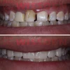 5 Pieces C14 Lithium Disilicate Blocks Cerec emax CAD Wissden Dental Glass Ceramic Cubes HT/LT CAD/CAM Manufacturer 5