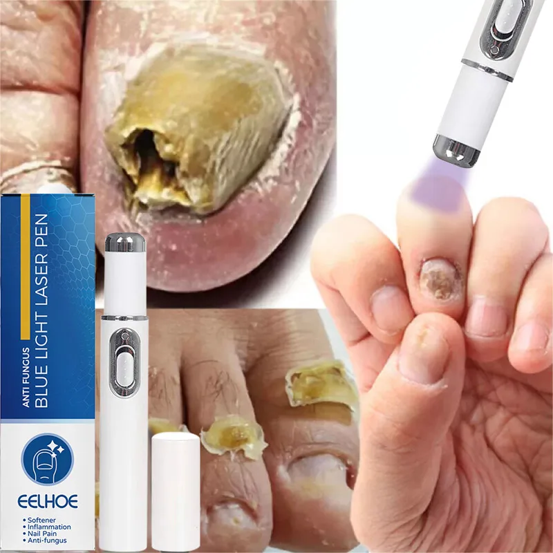 Nail Fungal Treatment Feet Care Essence Repair Nail Fungus Removal Serum Gel Anti Infection Paronychia Onychomycosis
