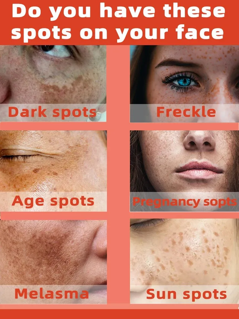

Fade Freckles Melasma and Dark Spots Anti Spots Essence