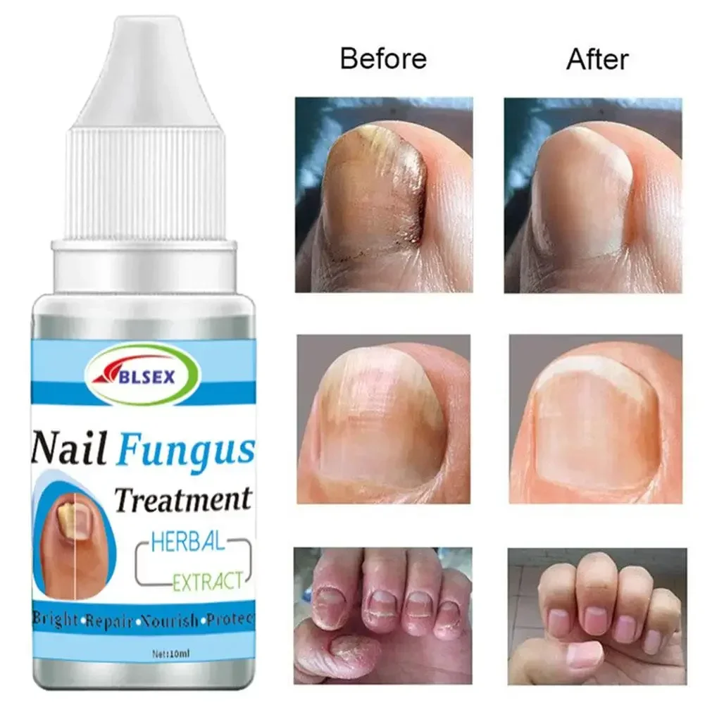 U&ntilde;as Fungus Nails Treatment for Fingernails Toenails Repair Onychomycosis Paronychia Anti Infection Toe Nail Fungal Removal