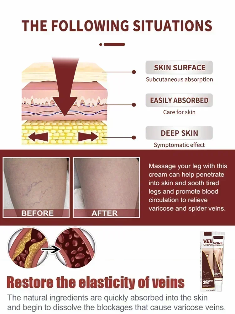 Safe and effective varicose vein removal Effective treatment of vasculitis Fast treatment of leg varicose vein removal Fast