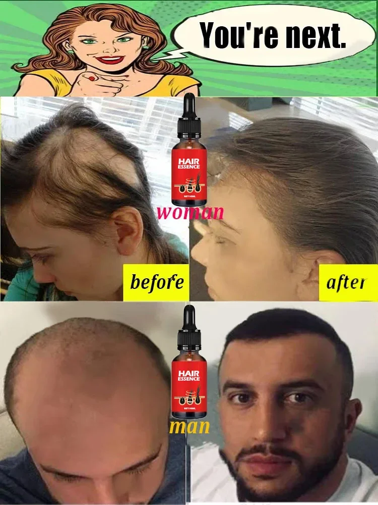 Dites Alfa &agrave; l'amincissement des cheveux, au soin des cheveux, &agrave; la r&eacute;paration et la pr&eacute;vention de l'amincissement cheveux