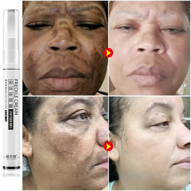 Crème blanchissante puissante pour taches de rousseur, élimine les taches foncées, les marques d'acné, estompe le mélasma, éclaircit la mélanine, hydrate, soin pour le visage, 10 pièces