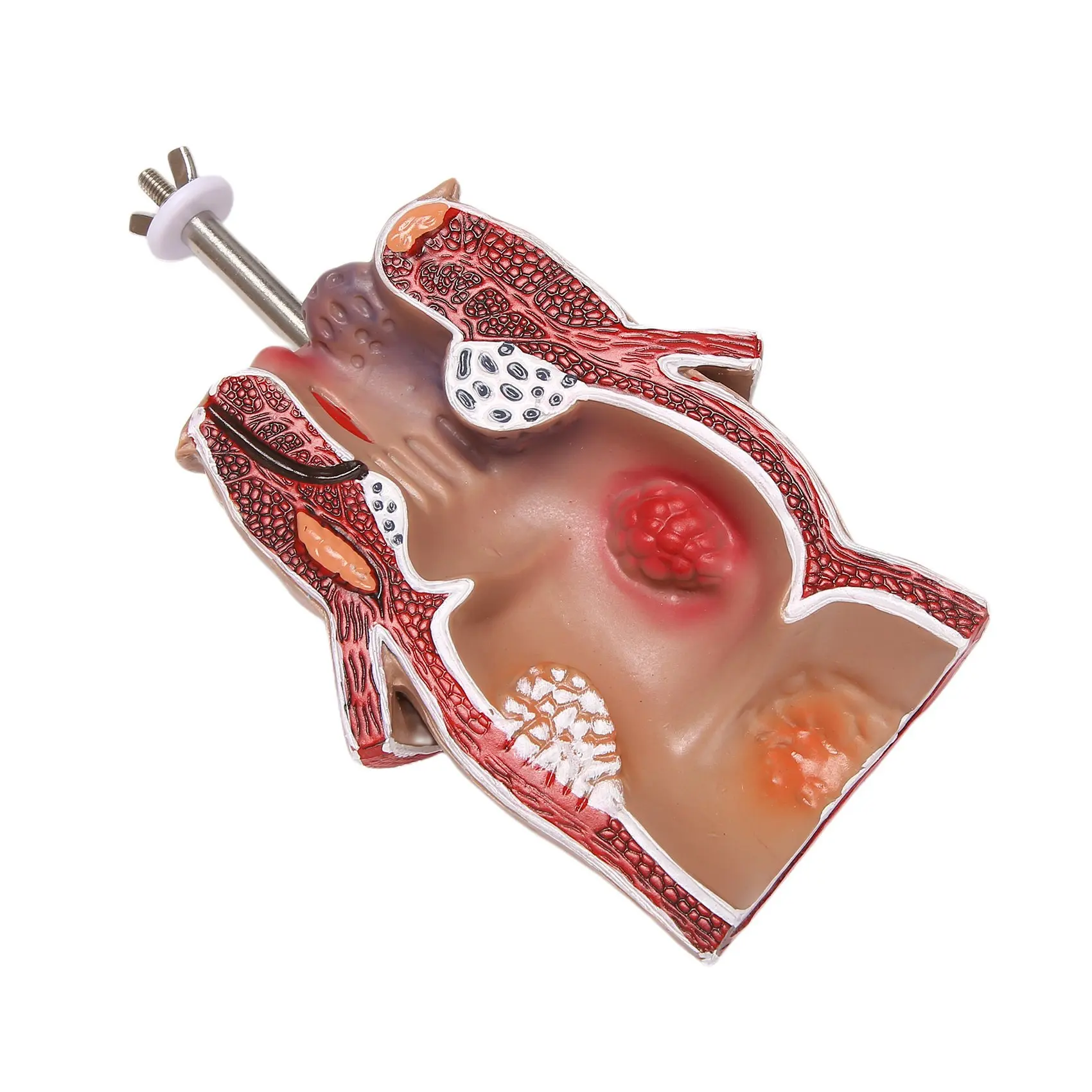 غ  ΰ  ġ   ġ ǰ Fistula fisure   