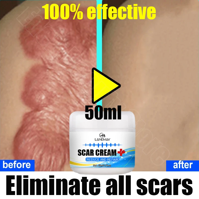 

Fast Scar Removal Cream Effective Treatment Stretch Marks Burn Surgical Scars Acne Spots Repair Whitening Moisturizing Skin Care