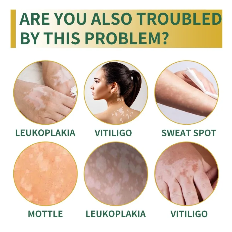 Effectively Remove Vitiligo Ointment Natural Repair Remove Ringworm White Spot Removal Skin Vitiligo Eliminate Skin Care 20g vitiligo ointment