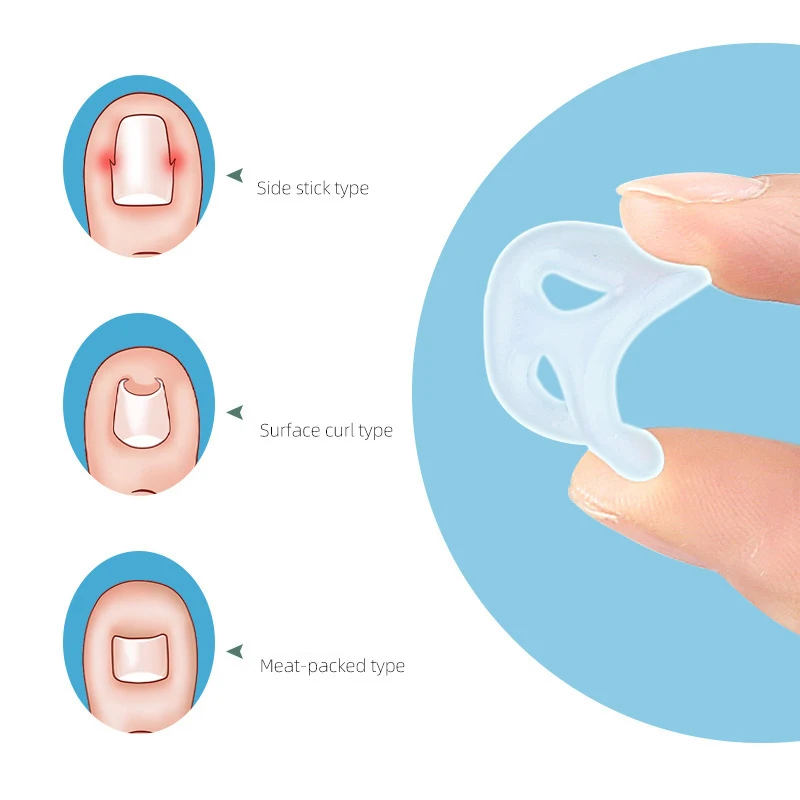 1/2pcs Silicone Ingrown Toenail Correction Tool Invisible Ingrown Toe Nail Straightening Protector Brace Pedicure Feet Care Tool