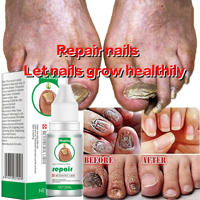 Nail Psoriasis vs. Nail Fungus: Photos and 5 Differences | MyPsoriasisTeam